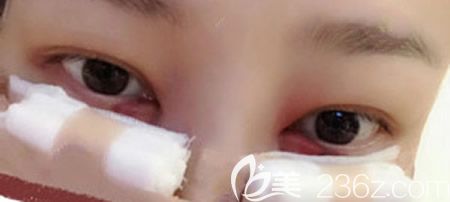 找贛州韓美整形吳彩霞做激光不開刀去眼袋術(shù)后第1天效果 找贛州韓美整形吳彩霞做激光不開刀去眼袋術(shù)后第1天效果