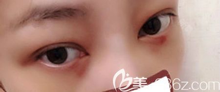 找贛州韓美整形吳彩霞做不開刀去眼袋術(shù)后第3天效果 找贛州韓美整形吳彩霞做不開刀去眼袋術(shù)后第3天效果