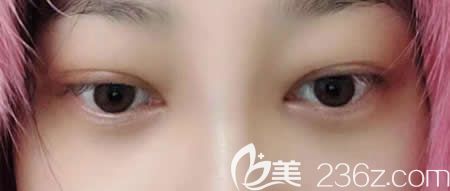 公開我去贛州韓美整形找吳彩霞做無痕祛眼袋術(shù)后1-10天恢復(fù)過程圖