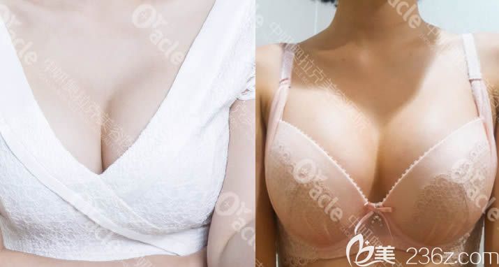 在長(zhǎng)春中妍奧拉克吸脂瘦大腿后，再用自體脂肪豐胸一舉兩得！