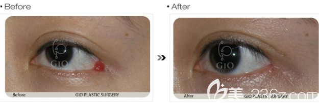 韓國GIO眼尾外露修復(fù)前后照片對比圖