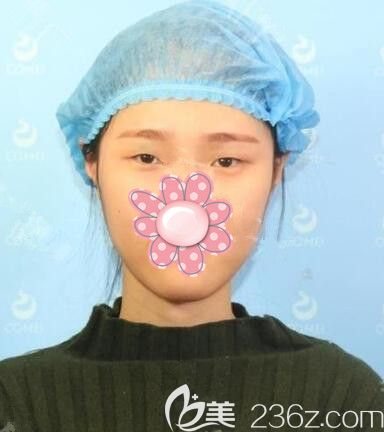 面診蘇州康美術前單眼皮 面診蘇州康美術前單眼皮