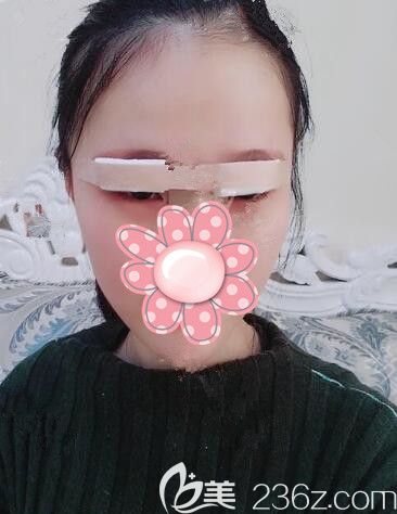 剛做完韓式精切雙眼皮術后即刻眼部腫脹 剛做完韓式精切雙眼皮術后即刻眼部腫脹