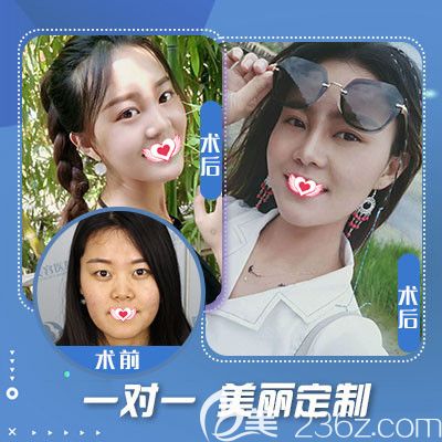 石家莊藍(lán)山注射玻尿酸案例 石家莊藍(lán)山注射玻尿酸案例