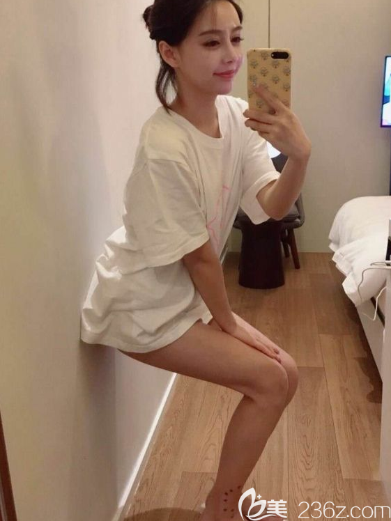 韓國寶士麗吸脂真人案例 韓國寶士麗吸脂真人案例