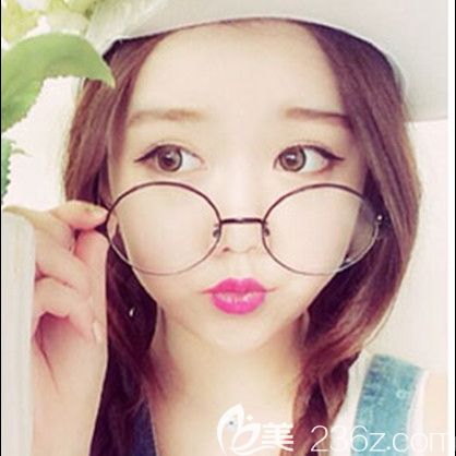 韓國id整形醫(yī)院好不好？納米脂肪移植+面部提升+顴骨降低案例術(shù)后效果