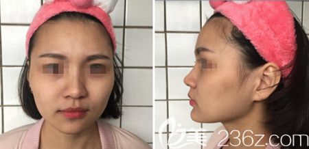 韓國佳輪韓做顴骨整形+面部吸脂手術(shù)前 韓國佳輪韓做顴骨整形+面部吸脂手術(shù)前