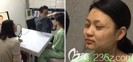 韓國佳輪韓做顴骨整形+面部吸脂手術(shù)當(dāng)天設(shè)計(jì) 韓國佳輪韓做顴骨整形+面部吸脂手術(shù)當(dāng)天設(shè)計(jì)