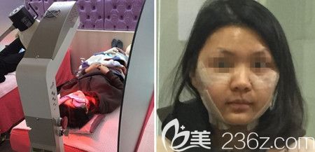 韓國佳輪韓做顴骨整形+面部吸脂手術(shù)后4天 韓國佳輪韓做顴骨整形+面部吸脂手術(shù)后4天