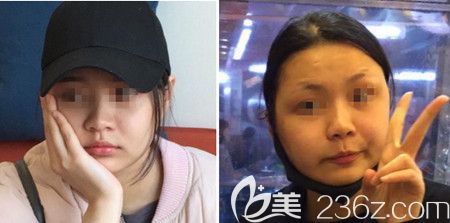 韓國佳輪韓做顴骨整形+面部吸脂手術(shù)后9天 韓國佳輪韓做顴骨整形+面部吸脂手術(shù)后9天