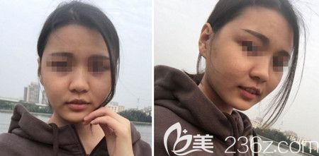 韓國佳輪韓做顴骨整形+面部吸脂手術(shù)后1個(gè)月 韓國佳輪韓做顴骨整形+面部吸脂手術(shù)后1個(gè)月