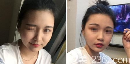 韓國佳輪韓做顴骨整形+面部吸脂手術(shù)后3個(gè)月 韓國佳輪韓做顴骨整形+面部吸脂手術(shù)后3個(gè)月