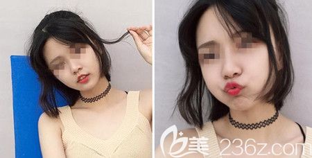 韓國佳輪韓做顴骨整形+面部吸脂手術(shù)后半年 韓國佳輪韓做顴骨整形+面部吸脂手術(shù)后半年