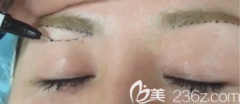 提眉切眉手術(shù)多少錢?湖州尚麗整形院長親診韓式微創(chuàng)切眉術(shù)價(jià)格5800元起