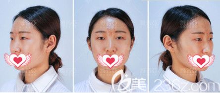 在石家莊雅芳亞做雙眼皮術(shù)前是無神單眼皮 在石家莊雅芳亞做雙眼皮術(shù)前是無神單眼皮