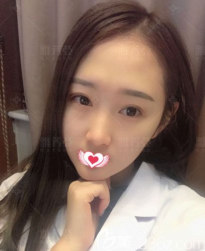 還在猶豫要不要做雙眼皮?我已經(jīng)在石家莊雅芳亞做切開雙眼皮+開眼角蛻變大眼美女