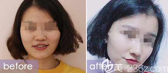 威海鼻綜合案例二