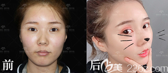 威海鼻綜合案例三