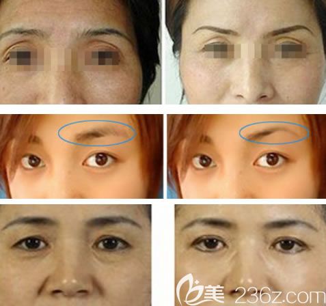 湖州尚麗宮玉展切眉手術(shù)案例 湖州尚麗宮玉展切眉手術(shù)案例