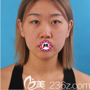 在北京美萊做膨體隆鼻和雙眼皮前樣子 在北京美萊做膨體隆鼻和雙眼皮前樣子