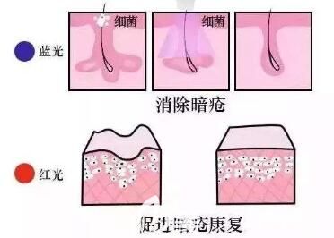 紅藍(lán)光祛痘原理