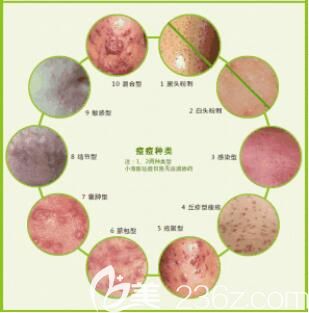紅藍(lán)光祛痘類型