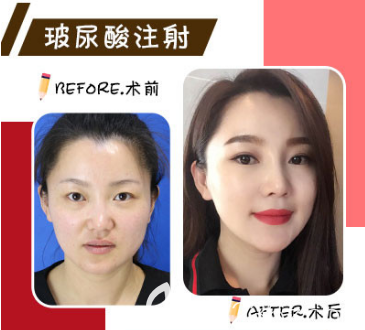 煙臺玻尿酸隆鼻案例 煙臺玻尿酸隆鼻案例