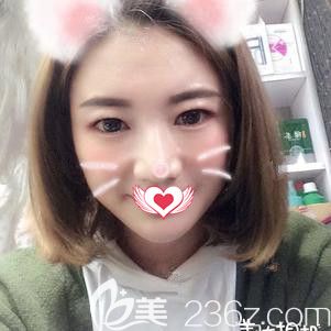 一直以為大方臉只能做面部吸脂來(lái)瘦臉 誰(shuí)知找石家莊藍(lán)山杜建龍?jiān)洪L(zhǎng)面診后做了自體脂肪面部填充術(shù)也能輕松變成心形臉