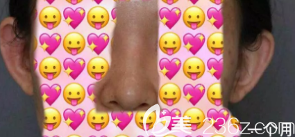 鼻綜合一個月的照片