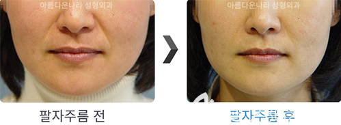 韓國吳金斯整形醫(yī)院埋線提升手術(shù)案例 韓國吳金斯整形醫(yī)院埋線提升手術(shù)案例