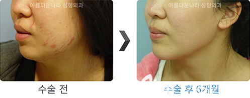 韓國吳金斯整形醫(yī)院面部吸脂手術(shù)對比案例 韓國吳金斯整形醫(yī)院面部吸脂手術(shù)對比案例