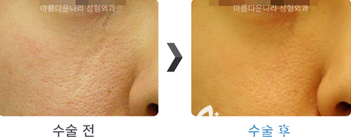 韓國吳金斯整形外科面部祛疤手術(shù)對比案例 韓國吳金斯整形外科面部祛疤手術(shù)對比案例