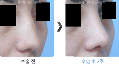 韓國吳金斯整形外科鷹鉤鼻矯正術(shù)前后照片對比圖 韓國吳金斯整形外科鷹鉤鼻矯正術(shù)前后照片對比圖