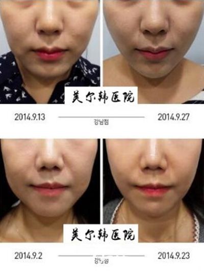 韓國美爾韓面部提升案例