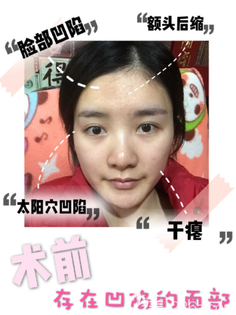 韓國(guó)寶士麗脂肪移植 韓國(guó)寶士麗脂肪移植