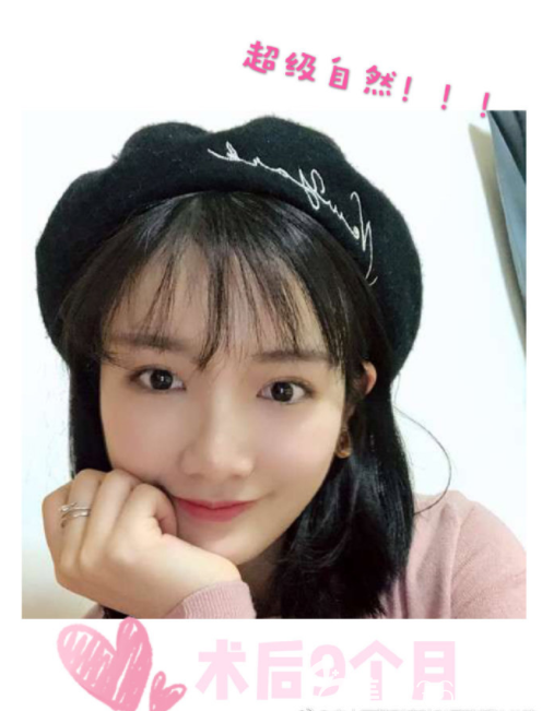 脂肪移植術(shù)后9個(gè)月 脂肪移植術(shù)后9個(gè)月