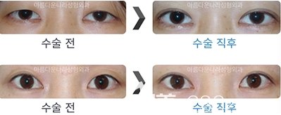 韓國吳金斯整形外科金鎮(zhèn)英院長雙眼皮、眼神矯正前后效果對比圖