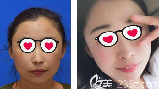 內(nèi)蒙古京美于曉昆激光祛斑案例 內(nèi)蒙古京美于曉昆激光祛斑案例