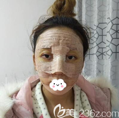 隆鼻豐下巴+面部脂肪填充術(shù)后即刻