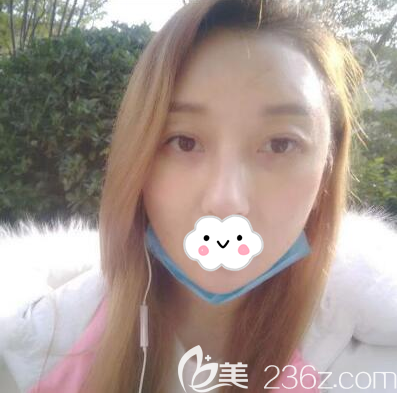 向朝肋軟骨隆鼻+自體脂肪全面部填充拆線后效果