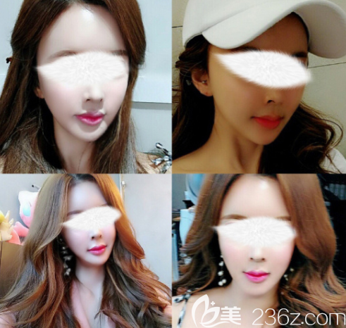 韓國博朗溫顴骨旋轉術+ 自體軟骨墊鼻基底真人案例 韓國博朗溫顴骨旋轉術+ 自體軟骨墊鼻基底真人案例