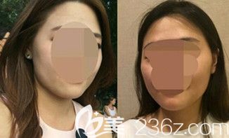 韓國博朗溫金兌奎顴骨旋轉(zhuǎn)術(shù)人字截骨輪廓手術(shù)案例集錦