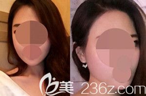 韓國博朗做輪廓怎么樣 韓國博朗做輪廓怎么樣