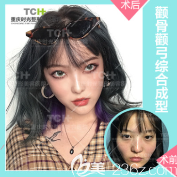 重慶時(shí)光磨骨改臉型案例