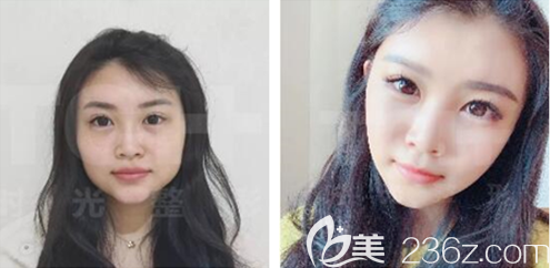 重慶時(shí)光下頜角整形案例