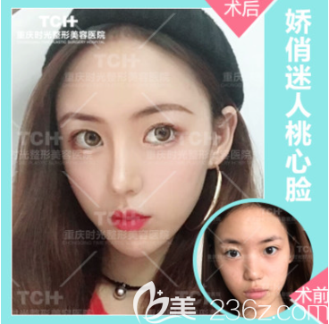 重慶時(shí)光面部脂肪填充