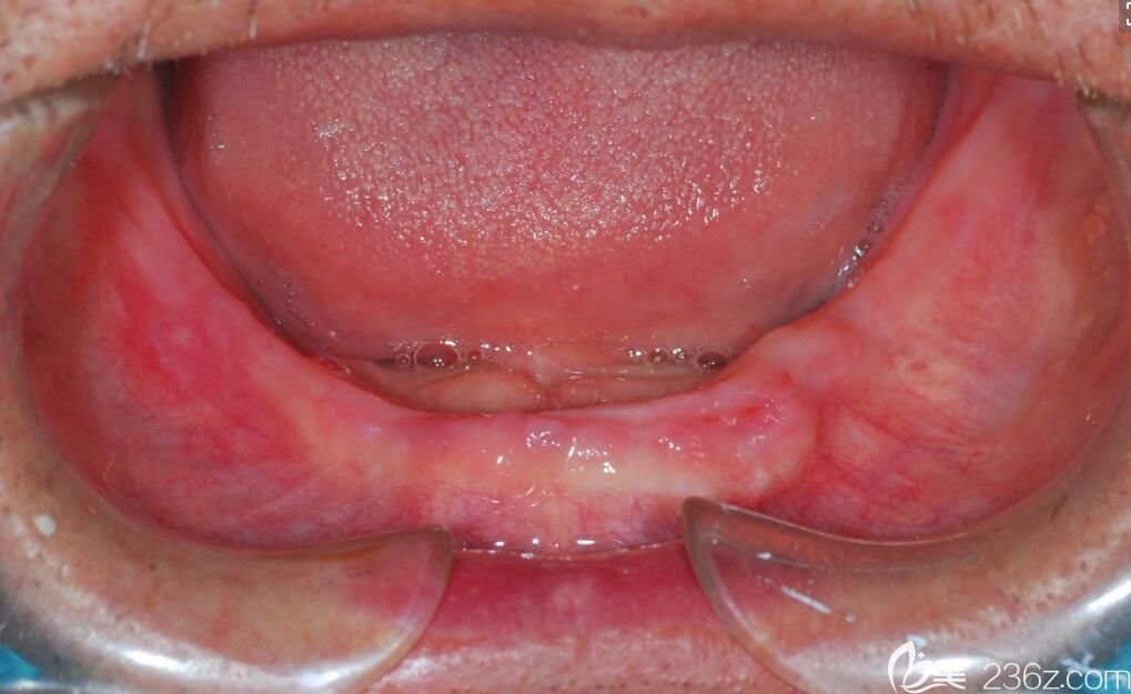 黃仁章醫(yī)生講解:全口牙缺失了該怎么辦才好.jpg 黃仁章醫(yī)生講解:全口牙缺失了該怎么辦才好.jpg