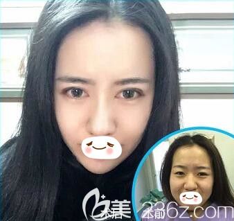 沈陽(yáng)元辰醫(yī)美陳軍做元生態(tài)雙眼皮真人前后對(duì)比照片