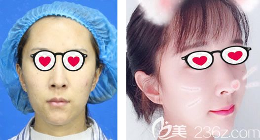 呼和浩特京美呂廣旭全臉脂肪填充效果怎么樣