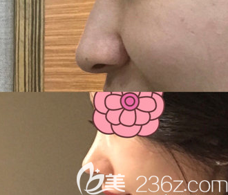 金貴洛隆鼻真人案例 金貴洛隆鼻真人案例